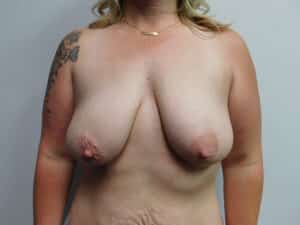 Before Image: Breast Augmentation with Mastopexy