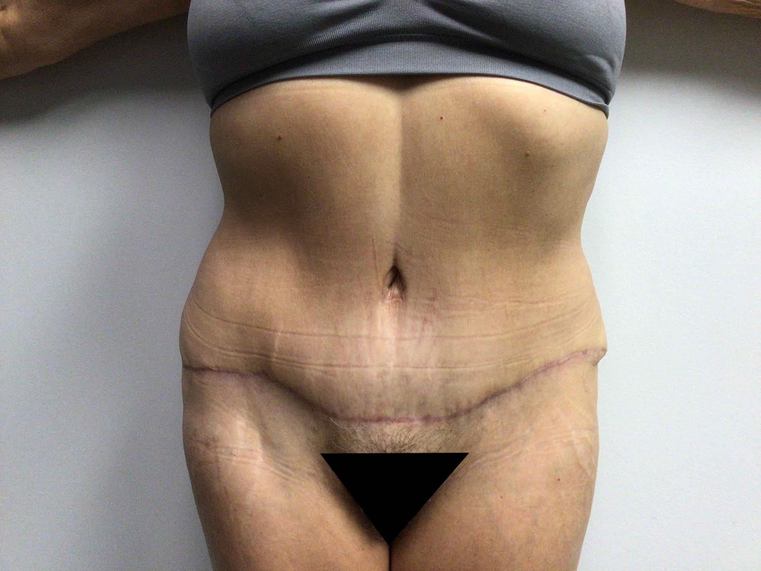After Image: Abdominoplasty - front