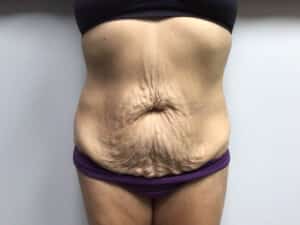 Before Image: Abdominoplasty