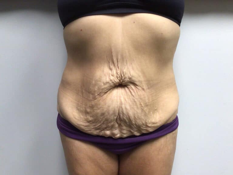 Before Image: Abdominoplasty - front