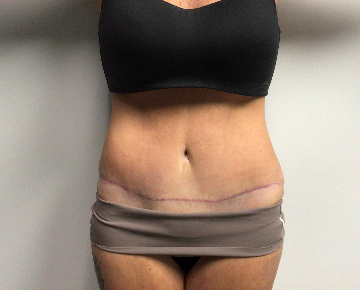 After Image: Abdominoplasty - front