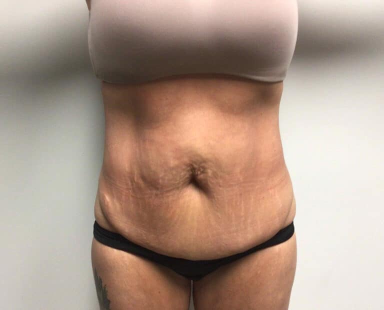 Before Image: Abdominoplasty - front