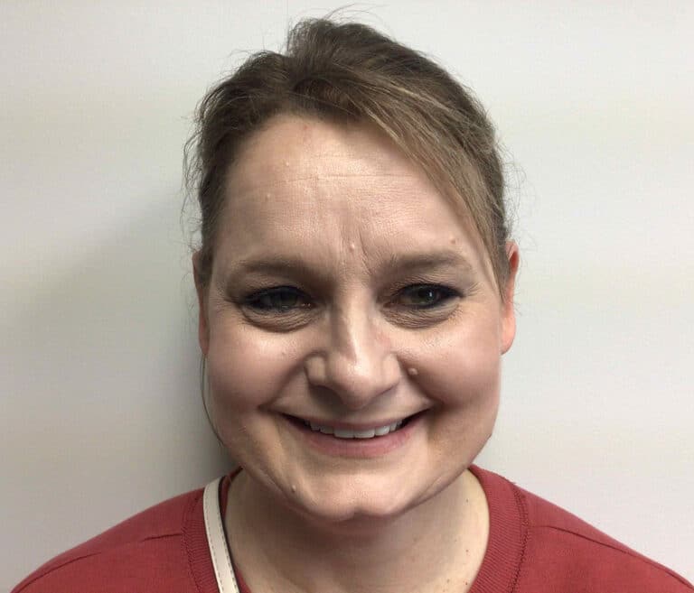 After Image: Otoplasty - front