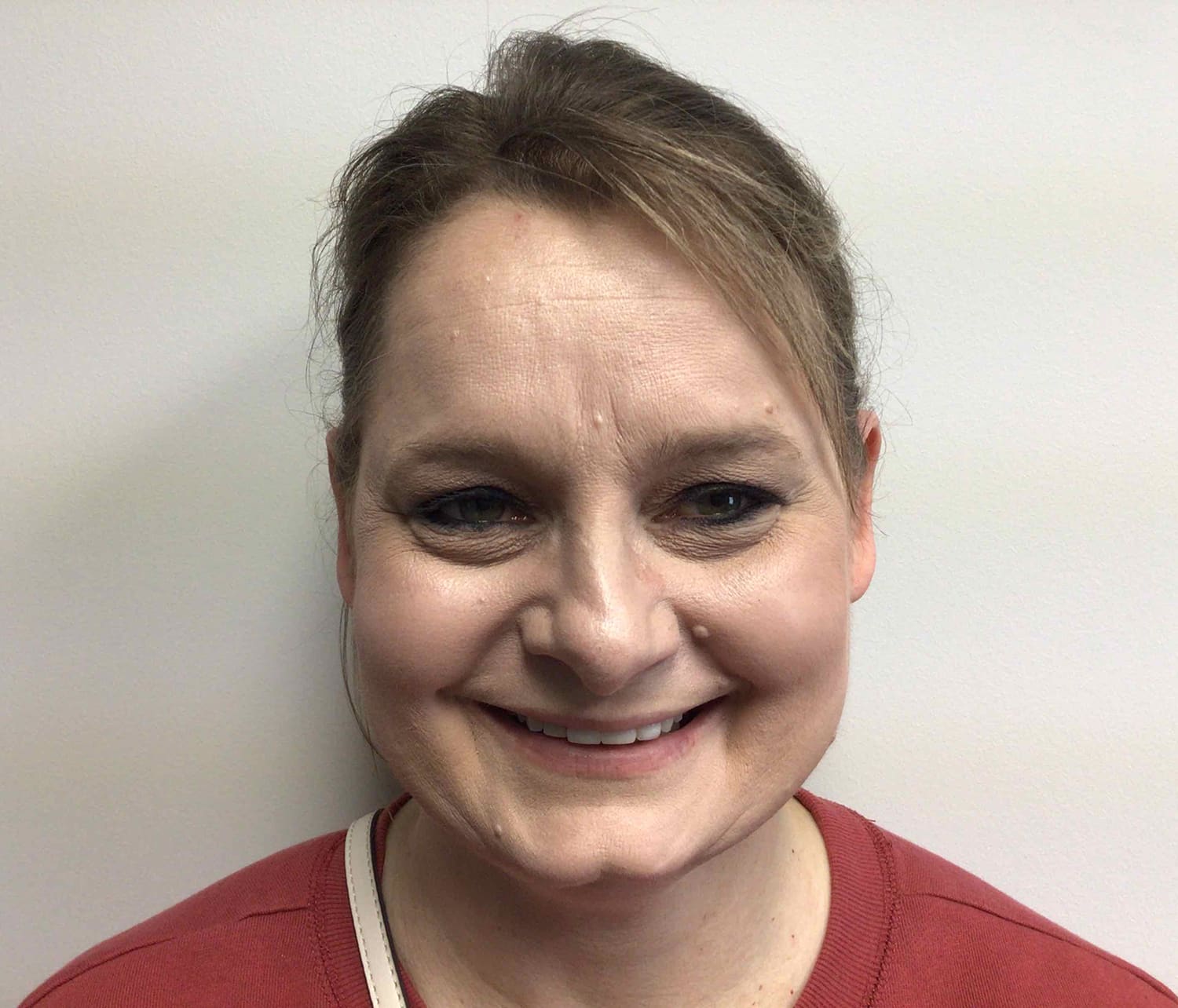 After Image: Otoplasty - front