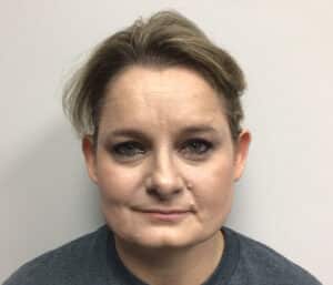 Before Image: Otoplasty