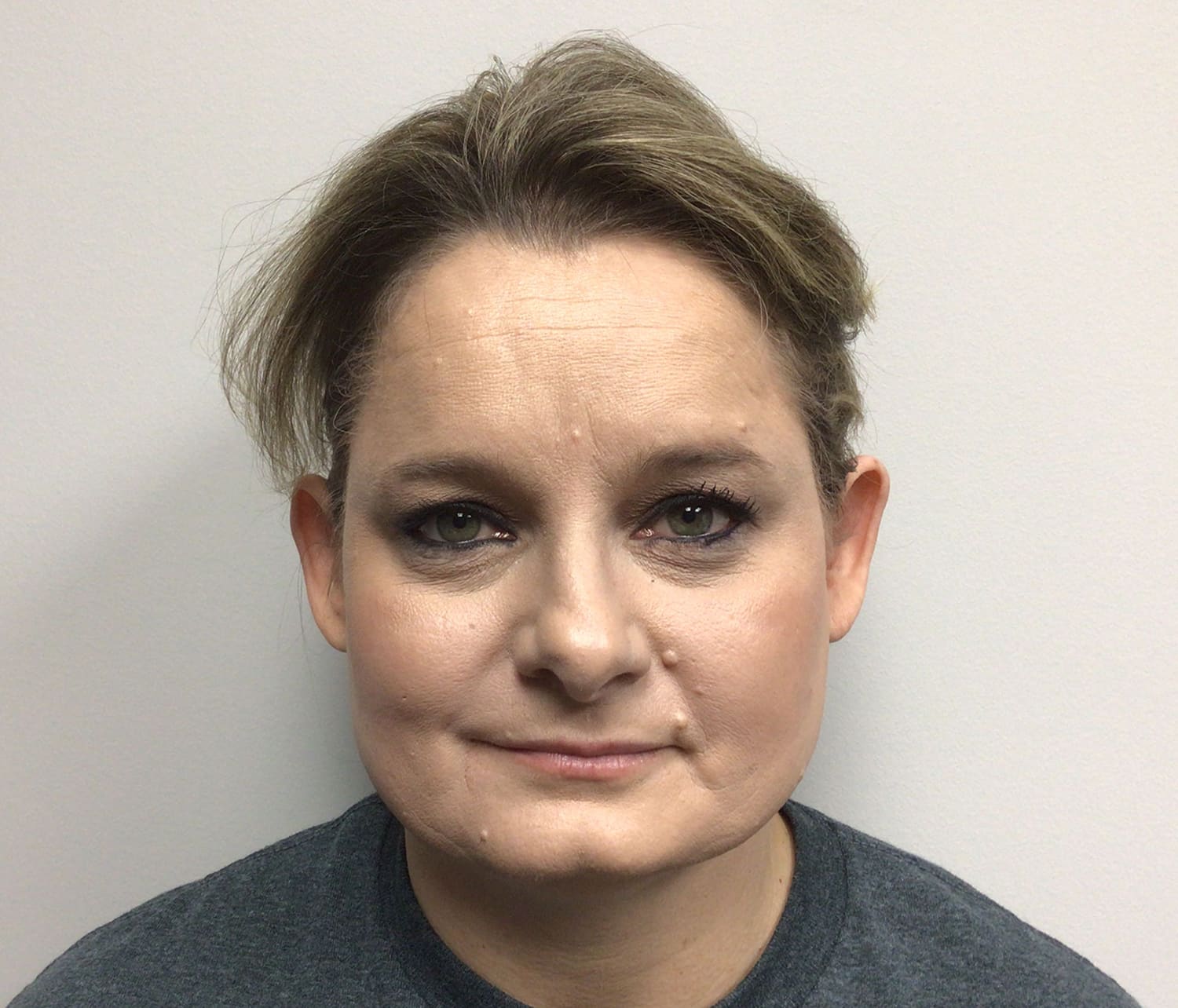 Before Image: Otoplasty - front