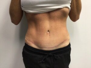 After Image: Abdominoplasty
