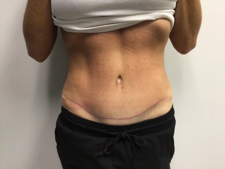 After Image: Abdominoplasty - front