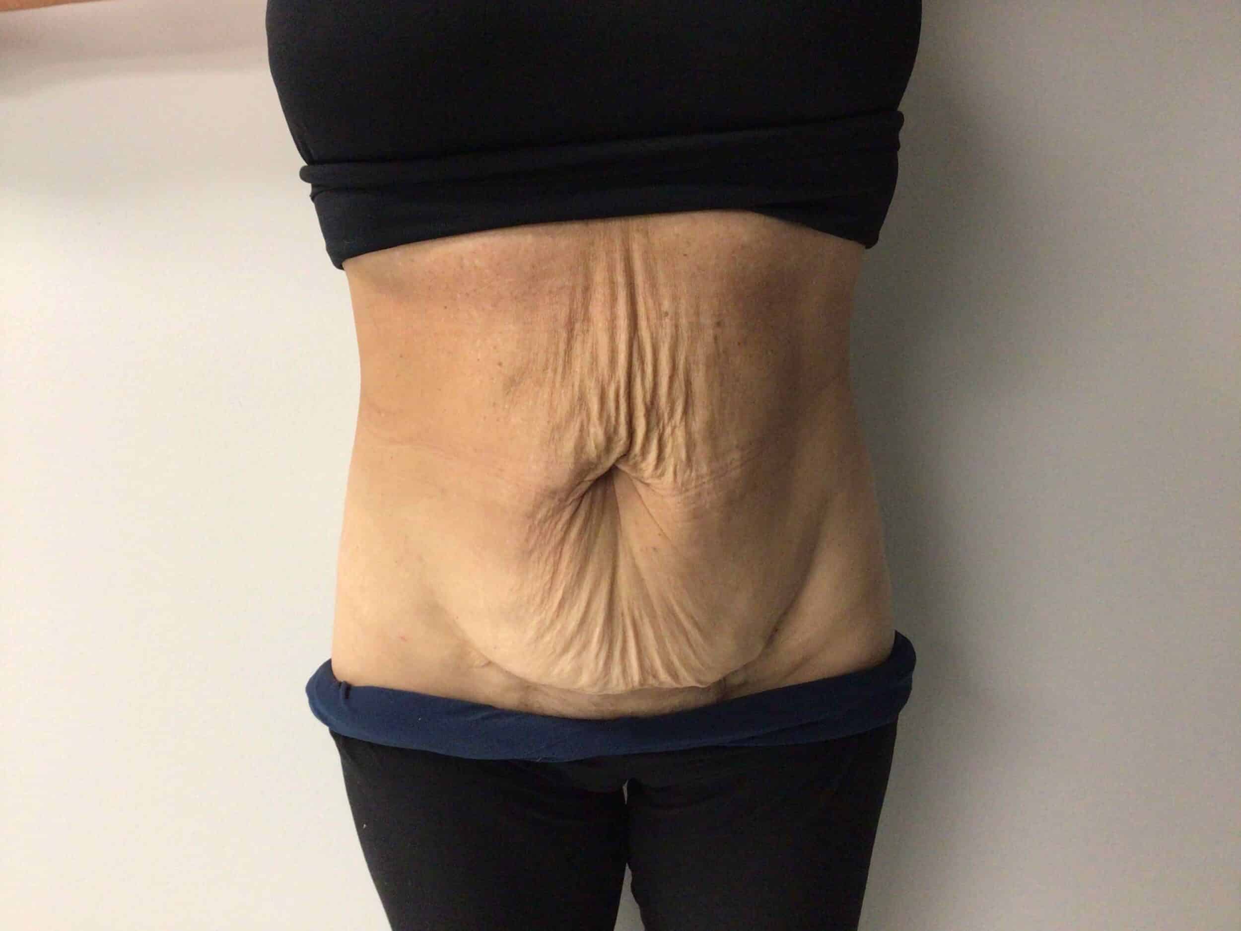 Before Image: Abdominoplasty - front