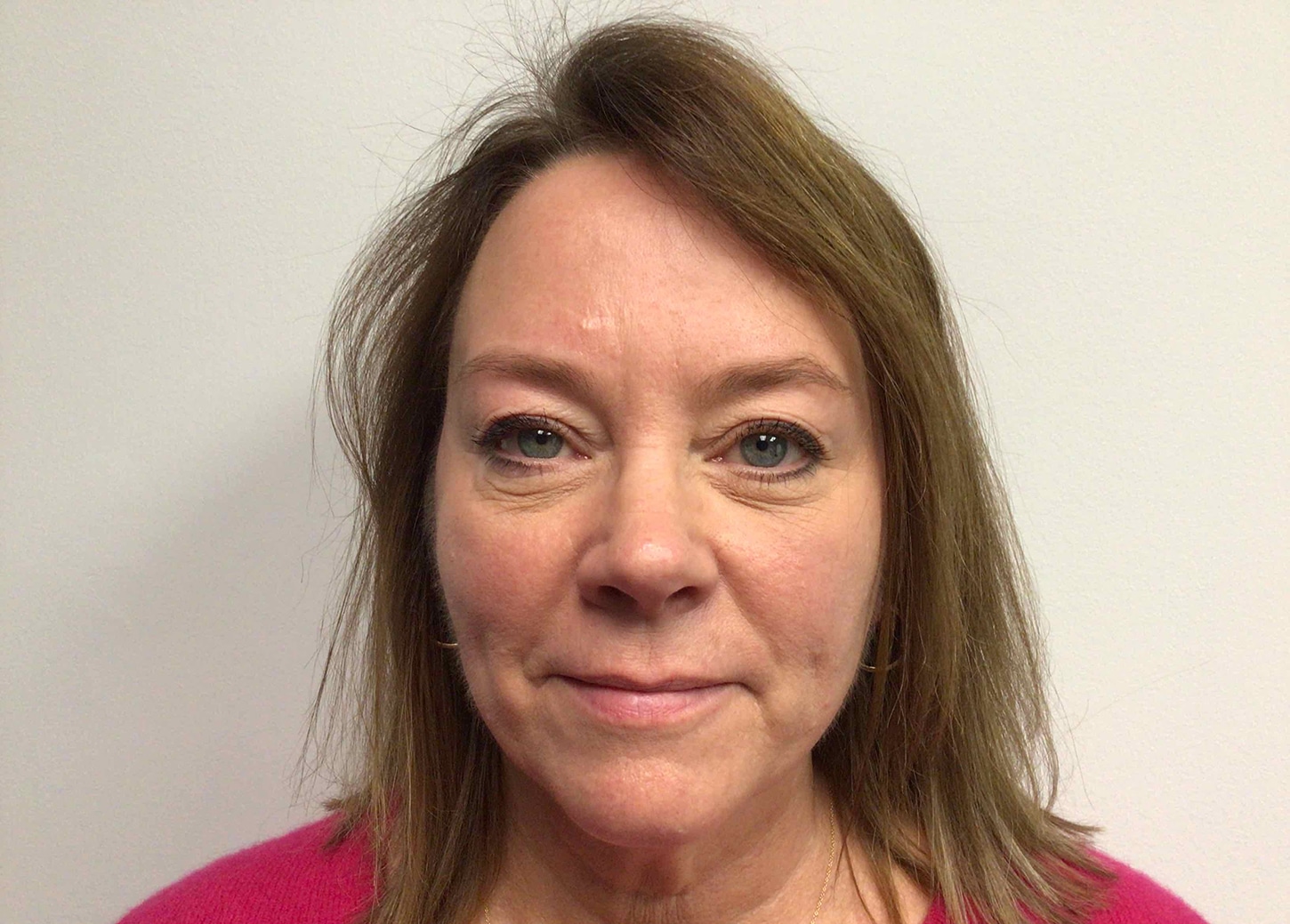 After Image: Blepharoplasty - front