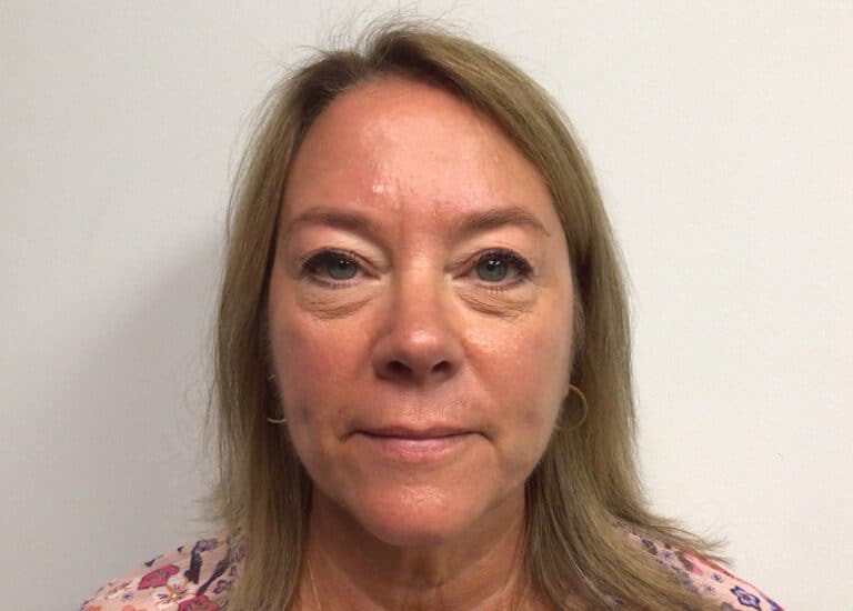 Before Image: Blepharoplasty - front