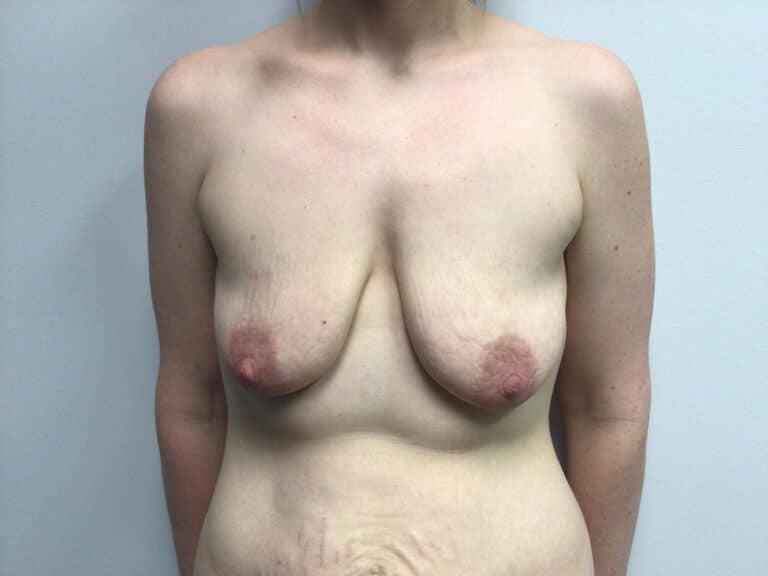 Before Image: Breast Augmentation with Mastopexy - front