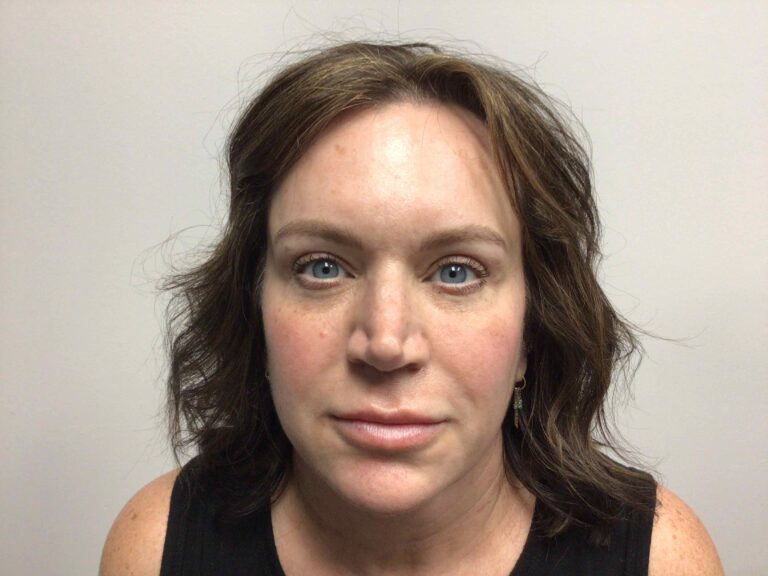 After Image: Blepharoplasty - front