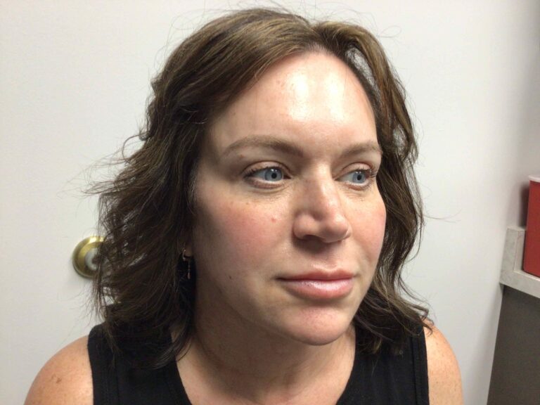 After Image: Blepharoplasty - right-front-oblique