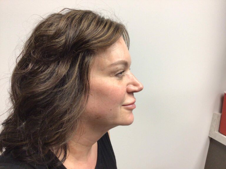 After Image: Blepharoplasty - right-side