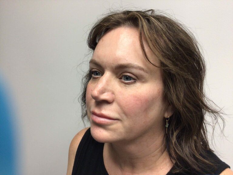 After Image: Blepharoplasty - left-front-oblique