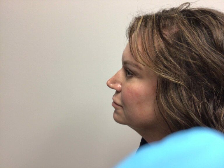 After Image: Blepharoplasty - left-side