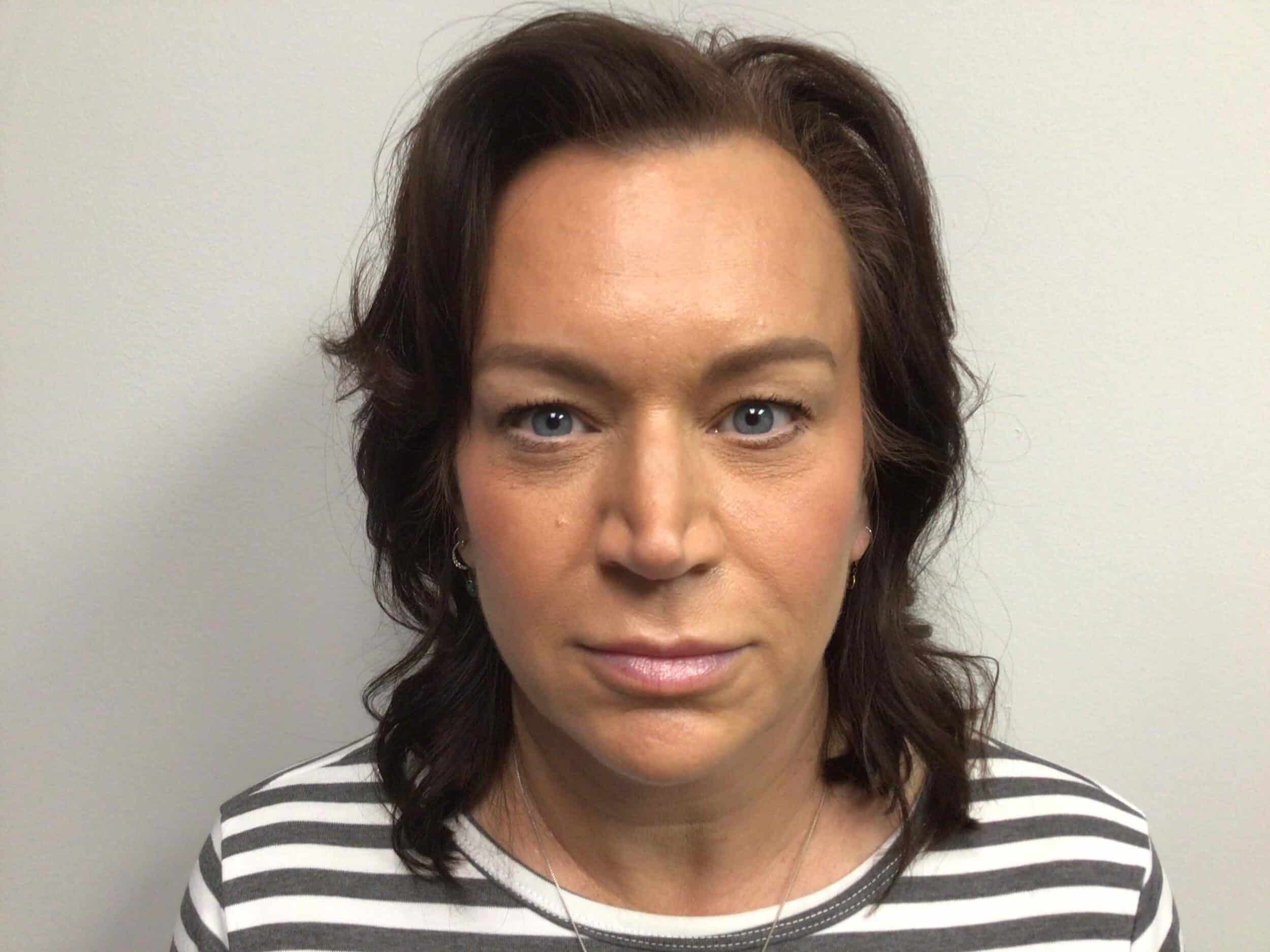 Before Image: Blepharoplasty - front
