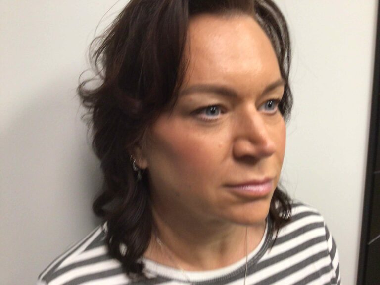 Before Image: Blepharoplasty - right-front-oblique