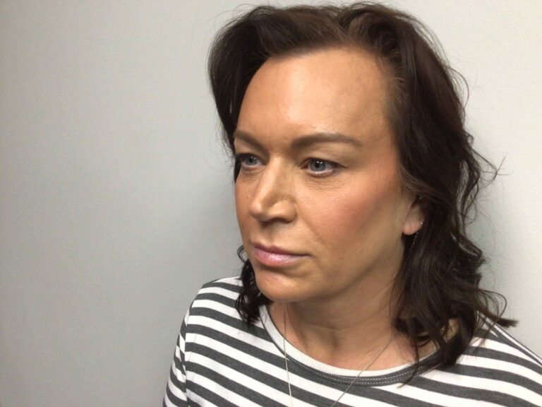 Before Image: Blepharoplasty - left-front-oblique