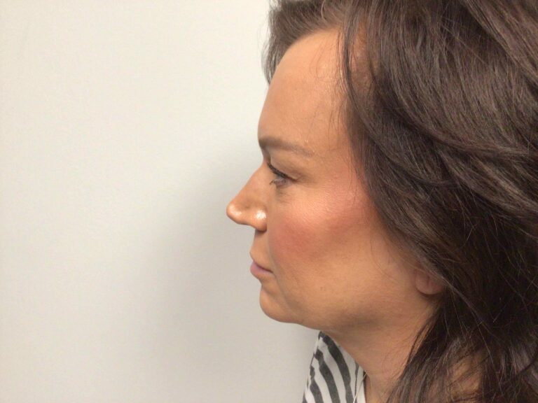 Before Image: Blepharoplasty - left-side