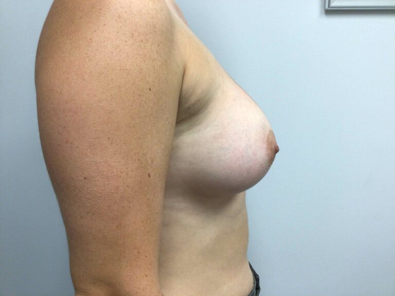After Image: Breast Augmentation - right-side