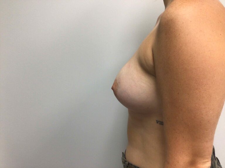 After Image: Breast Augmentation - left-side