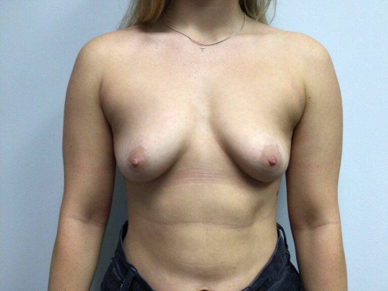 Before Image: Breast Augmentation - front