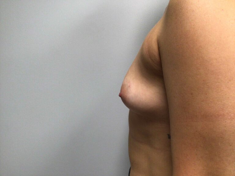 Before Image: Breast Augmentation - left-side