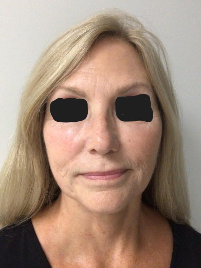 After Image: Facelift - front