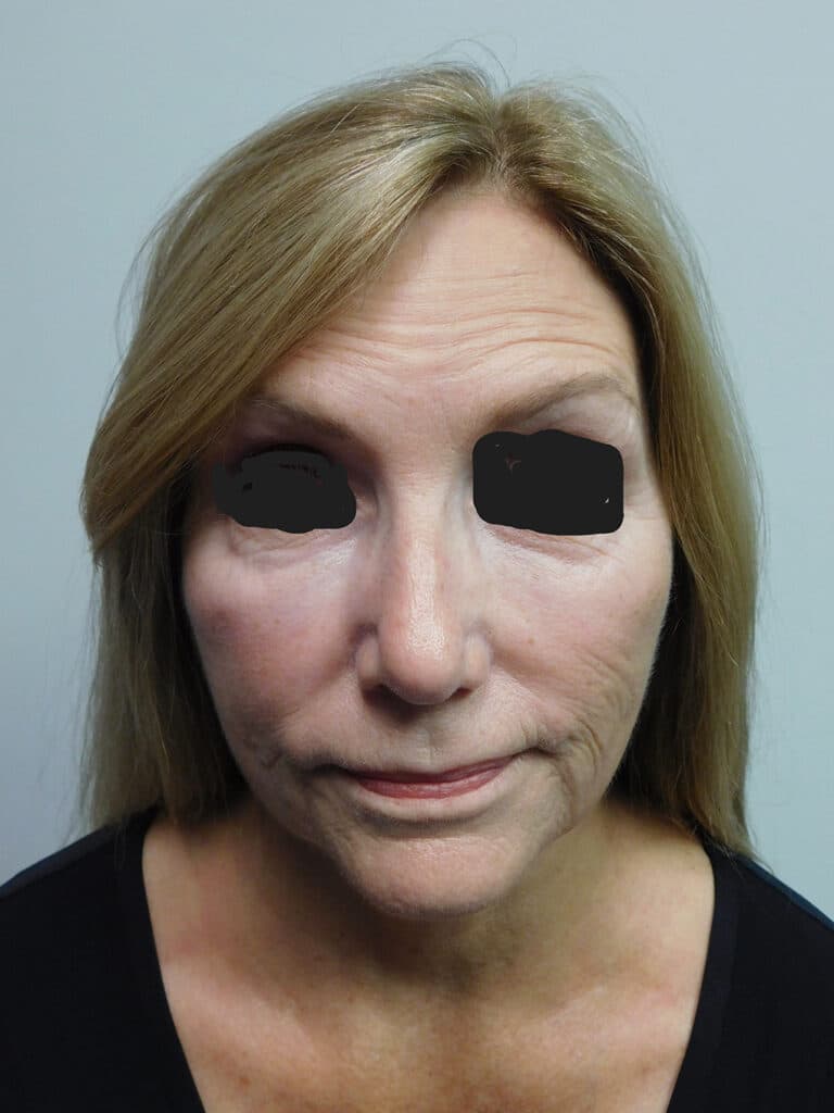 Before Image: Facelift - front