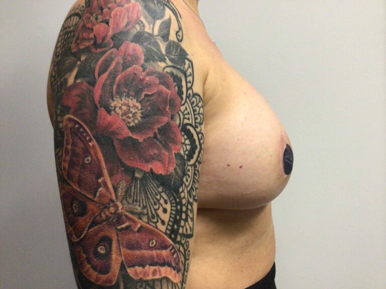 After Image: Breast Augmentation with Mastopexy - right-side