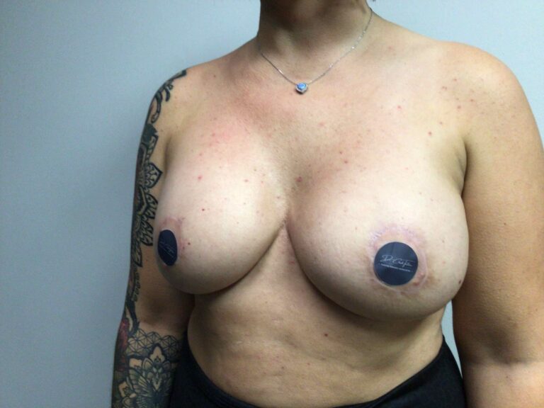 After Image: Breast Augmentation with Mastopexy - left-front-oblique