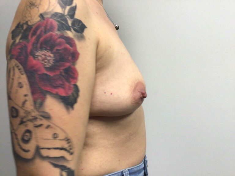 Before Image: Breast Augmentation with Mastopexy - right-side