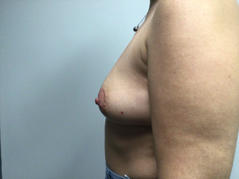 Before Image: Breast Augmentation with Mastopexy - left-side