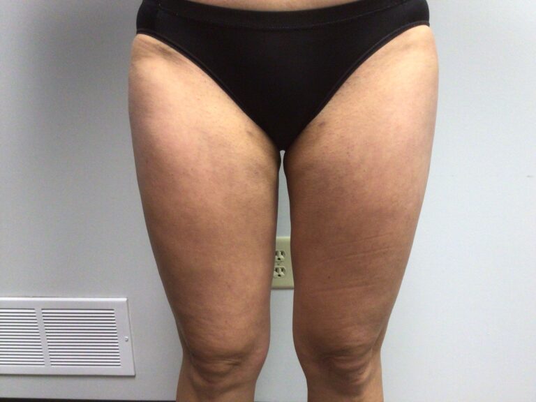After Image: Liposuction - front