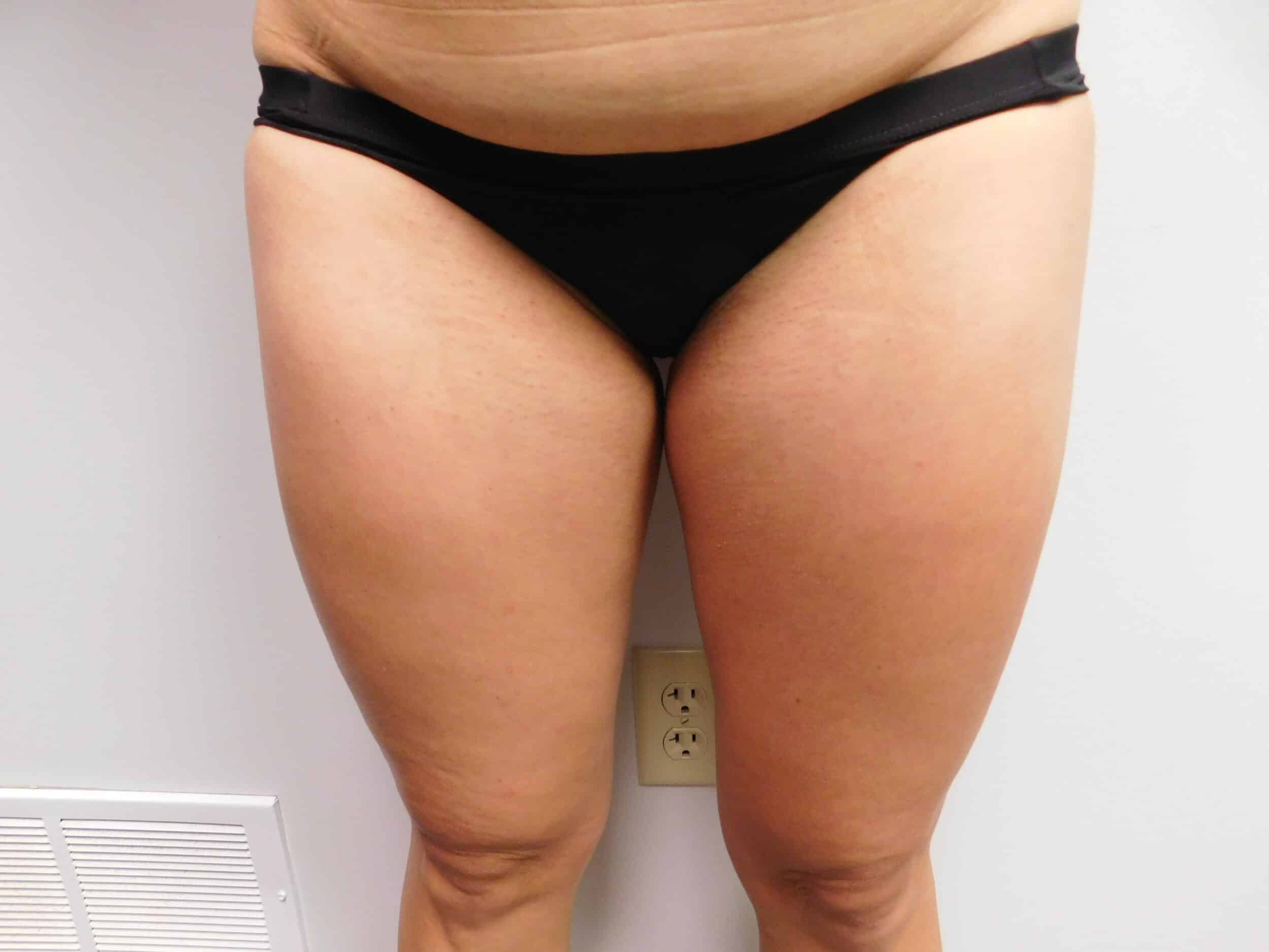 Before Image: Liposuction - front