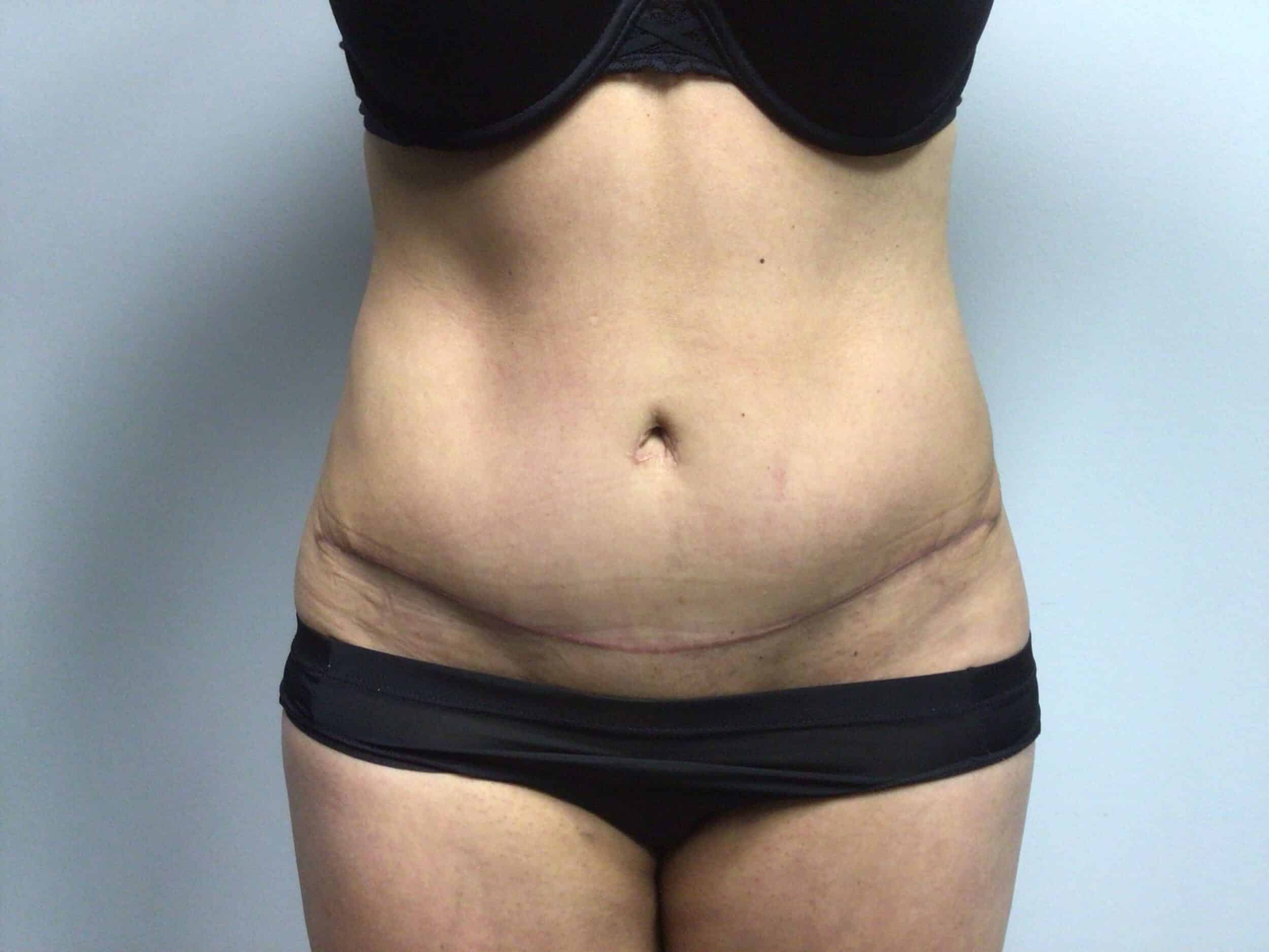 After Image: Abdominoplasty - front