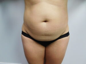 Before Image: Abdominoplasty