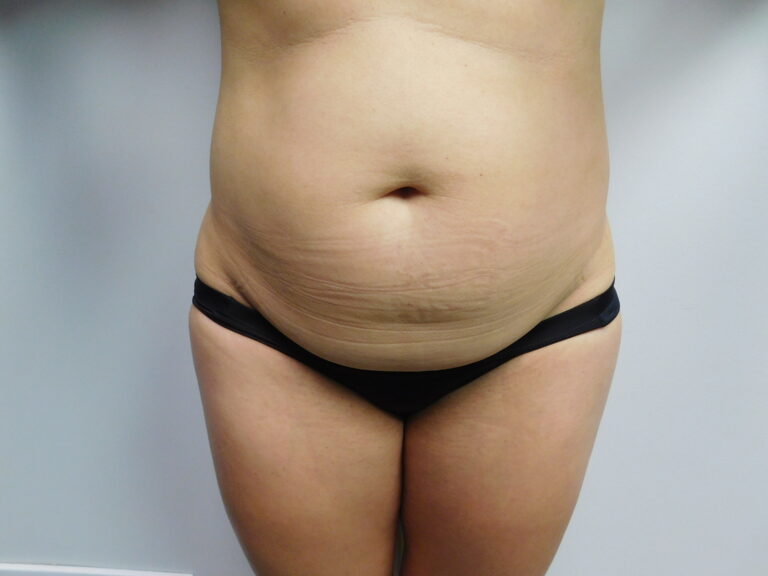 Before Image: Abdominoplasty - front