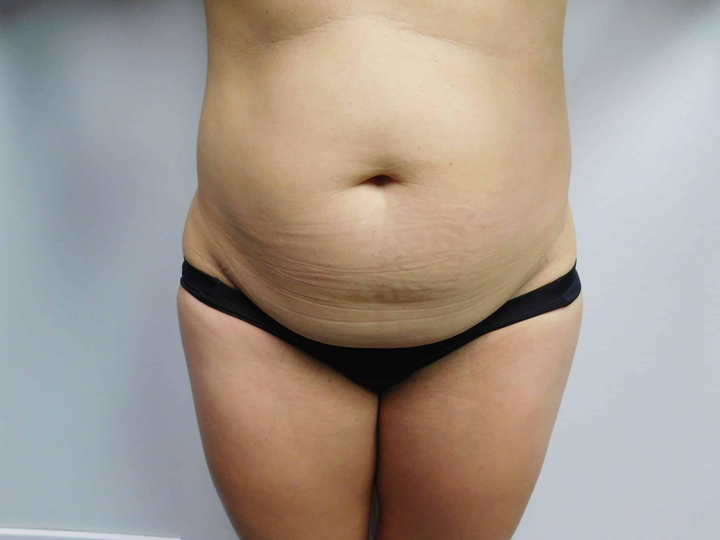 Before Image: Abdominoplasty - front