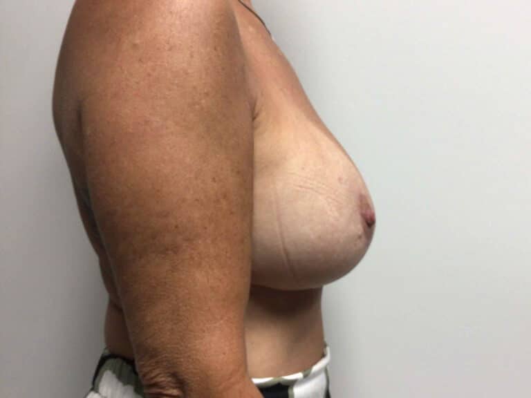 After Image: Breast Augmentation with Lift - right-side