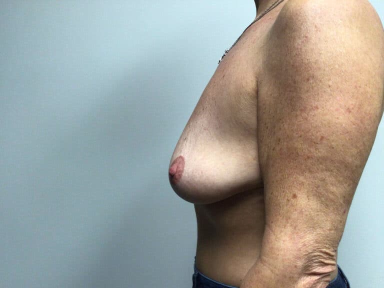 Before Image: Breast Augmentation with Lift - left-side