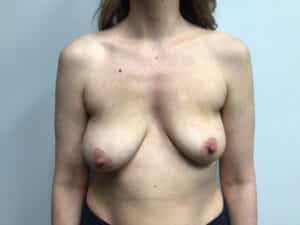 Before Image: Breast Augmentation/Mastopexy