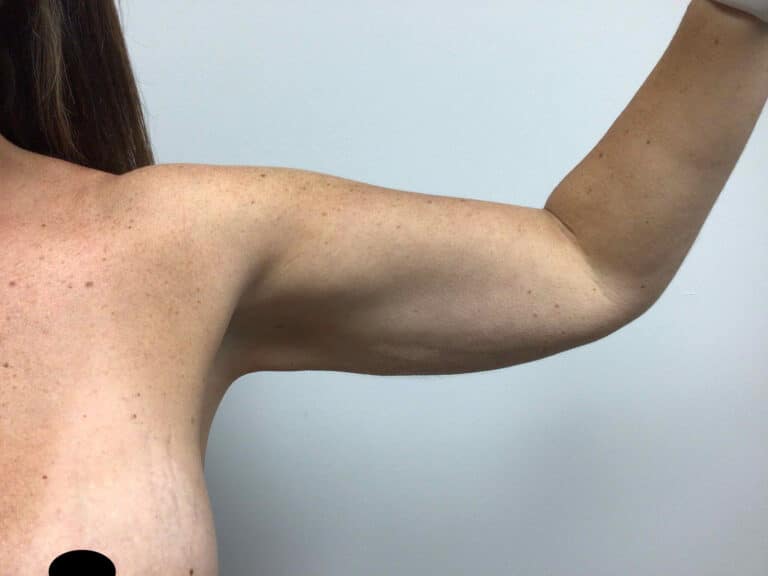 After Image: Arm Liposuction - front