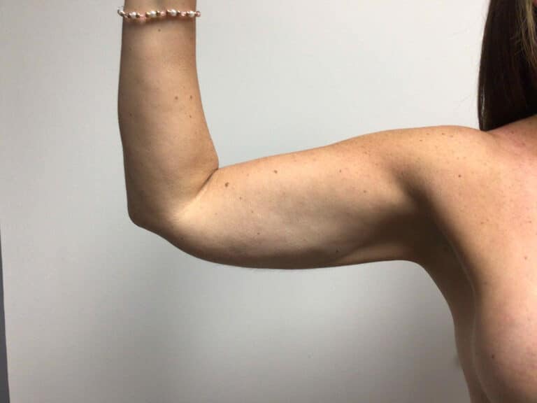 After Image: Arm Liposuction - front