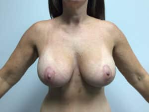 After Image: Breast Augmentation/Mastopexy