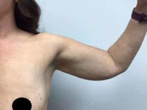 Before Image: Arm Liposuction