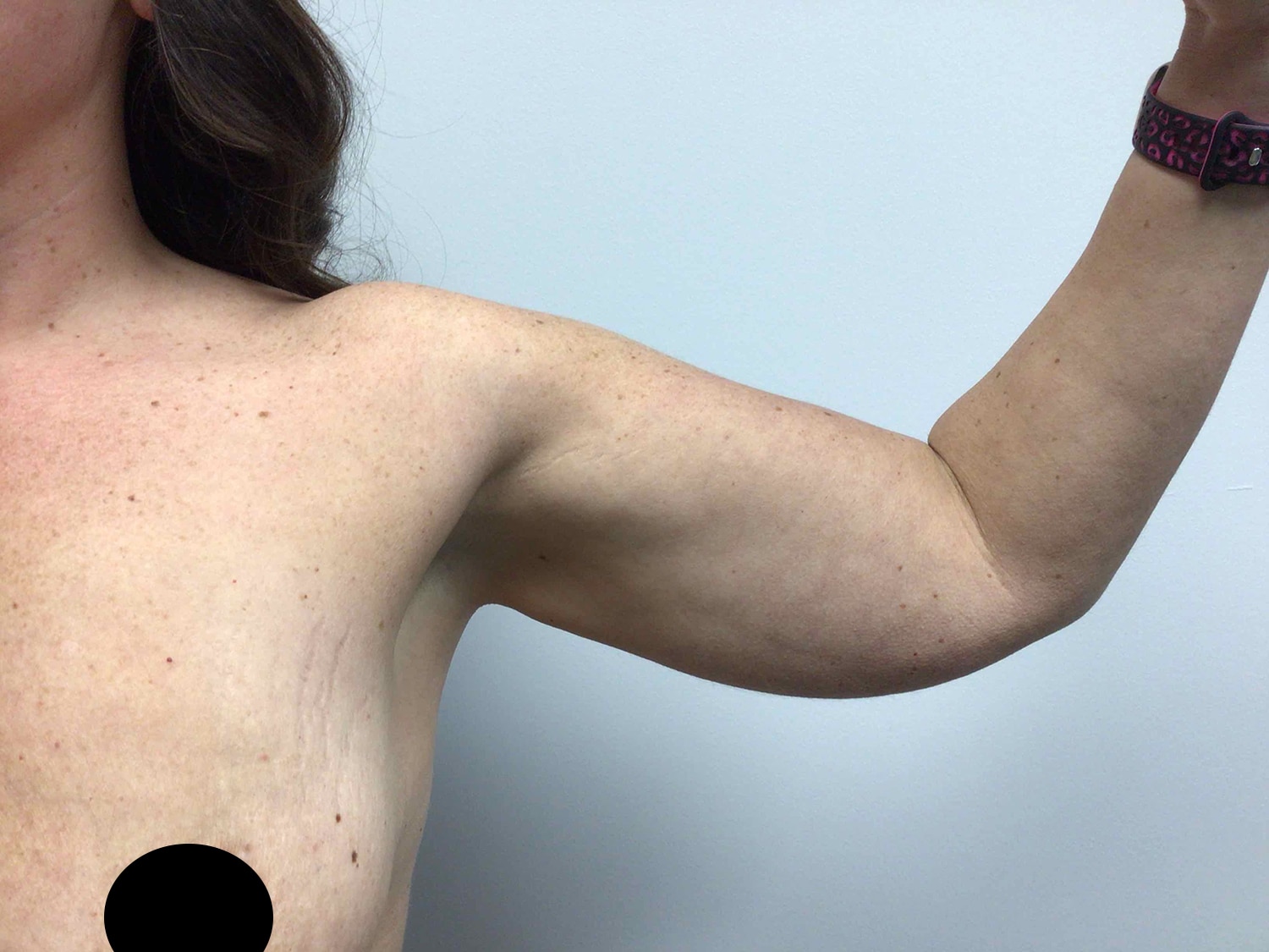 Before Image: Arm Liposuction - front
