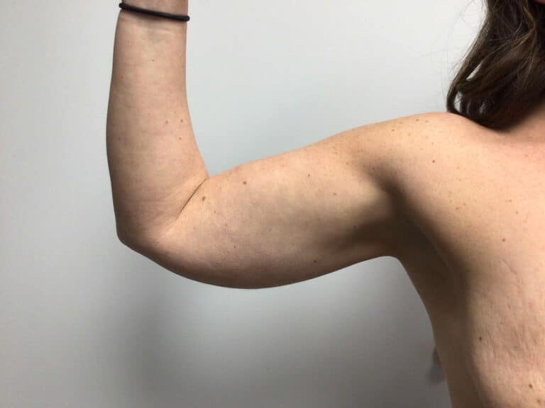Before Image: Arm Liposuction - front